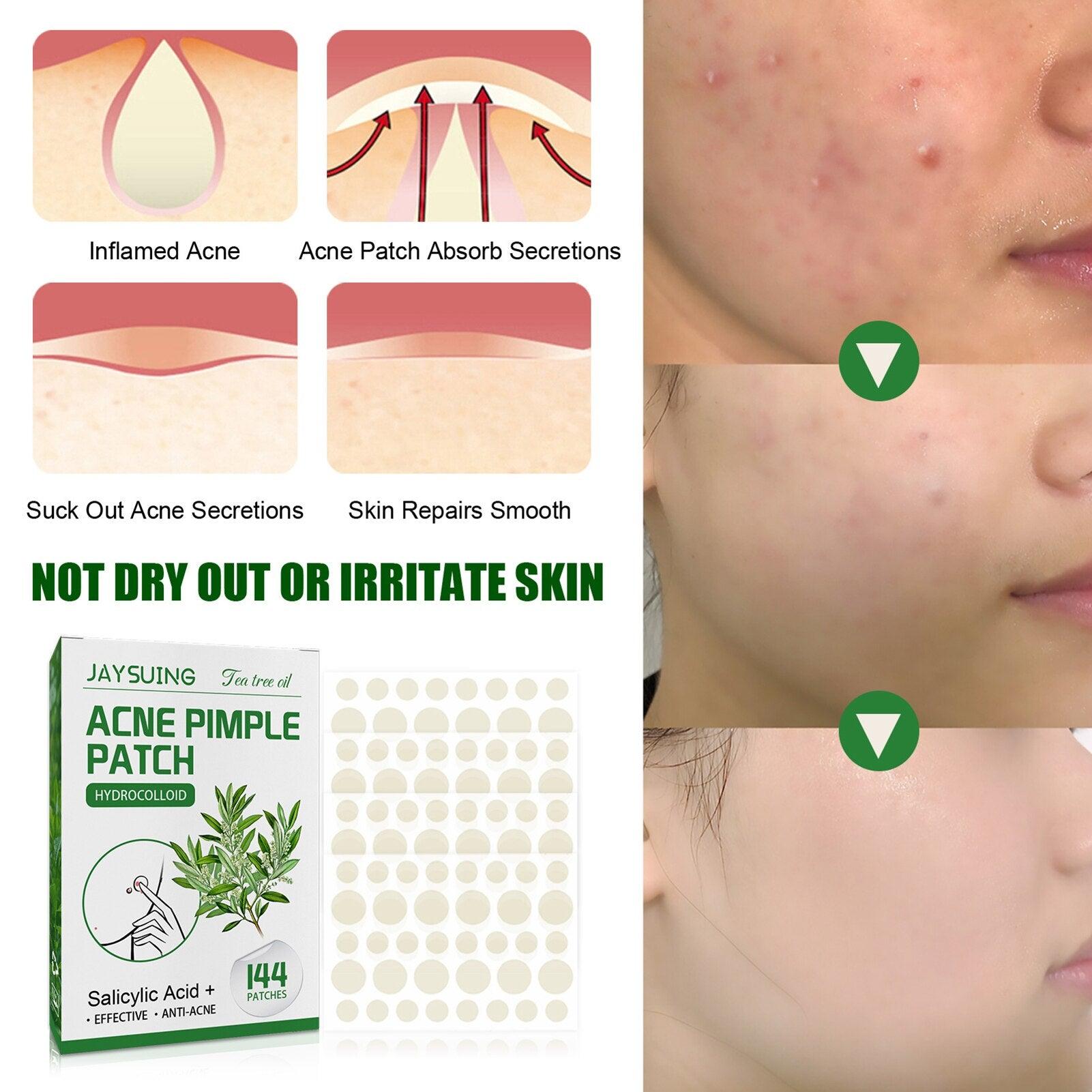 Acne Pimple Patches - ItemBear.com