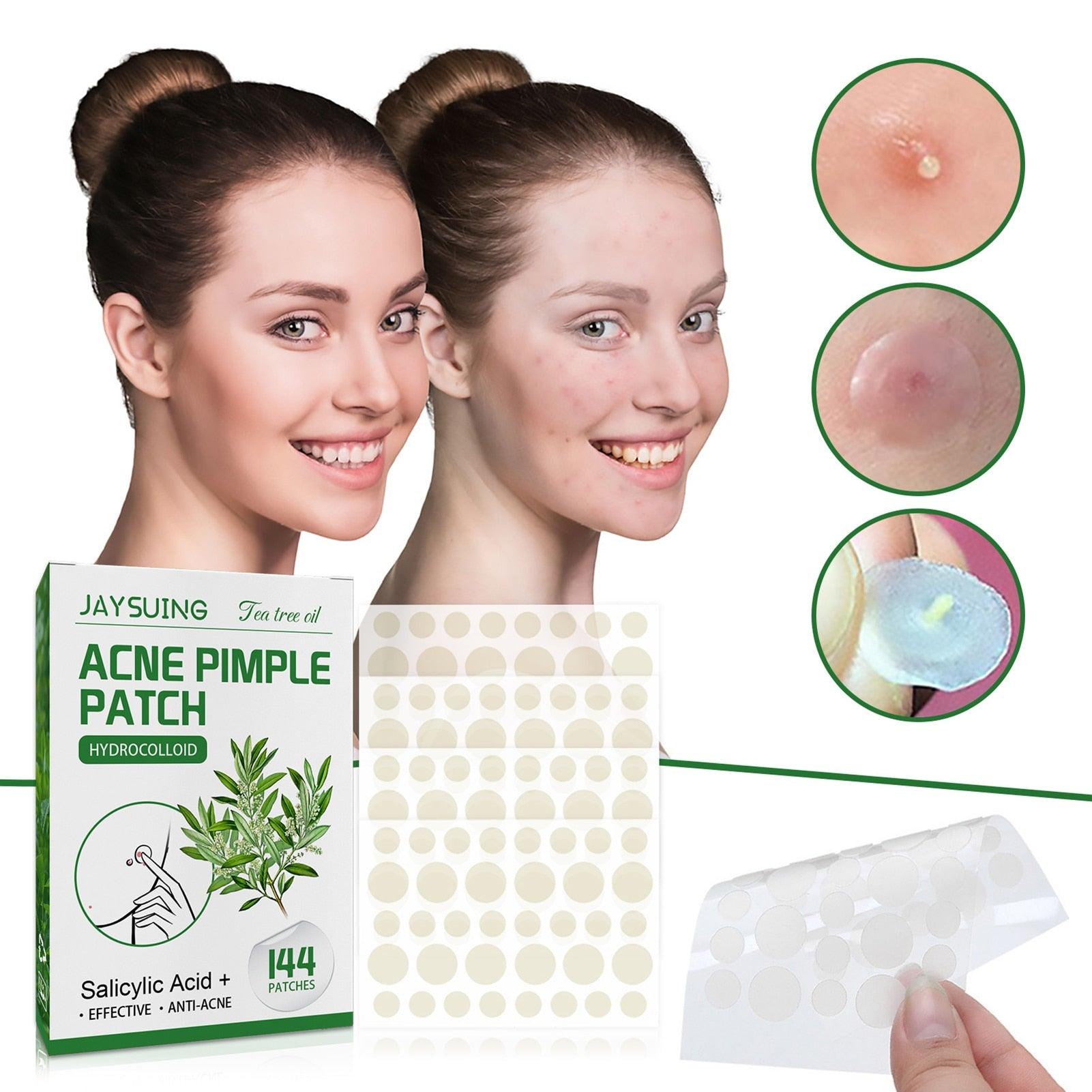 Acne Pimple Patches - ItemBear.com