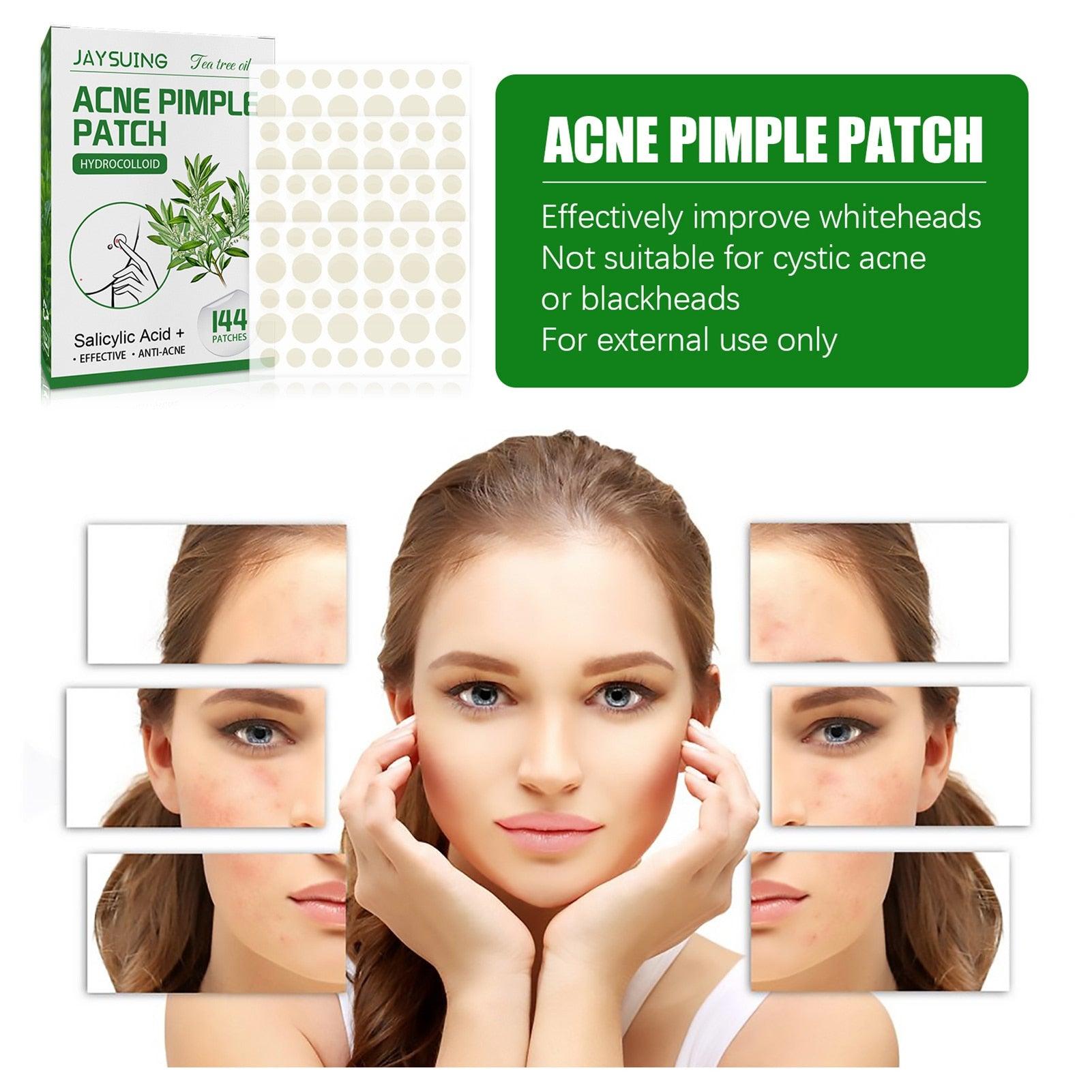 Acne Pimple Patches - ItemBear.com