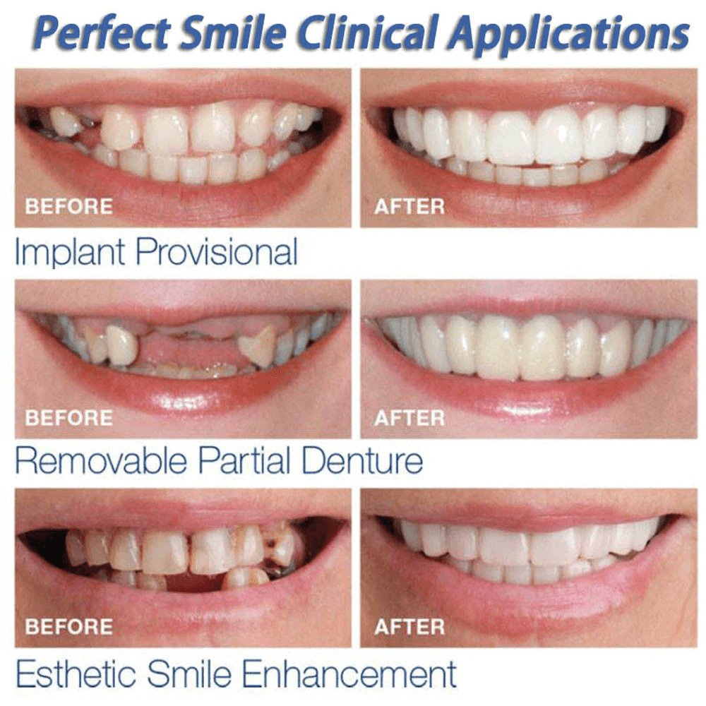 Instant Perfect Smile Dental Veneers - ItemBear.com