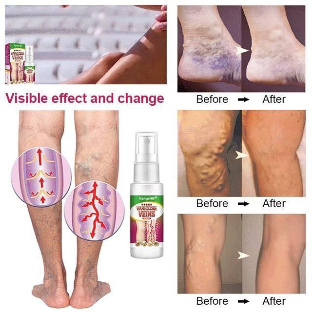 Varicose Veins Treatment Spray - ItemBear.com