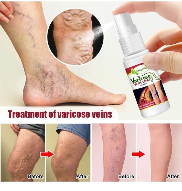 Varicose Veins Treatment Spray - ItemBear.com